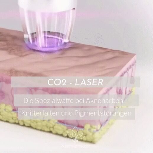 CO2-Laser zur Narbenkorrektur im AESTHETIKON