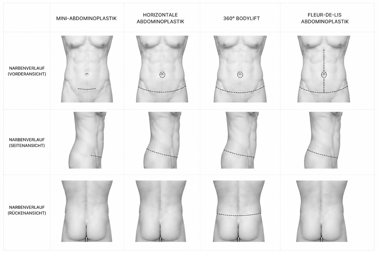 Narbenverlauf beim Mann bei Mini-Abdominoplastik, horizontaler Abdominoplastik, 360-Grad-Bodylift und Fleur-de-Lis-Abdominoplastik in Vorder-, Seiten- und Rückenansicht