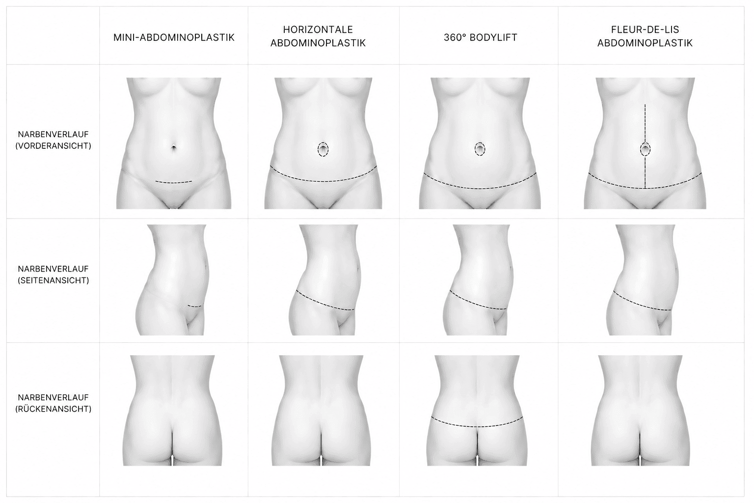 Narbenverlauf bei Mini-Abdominoplastik, horizontaler Abdominoplastik, 360-Grad-Bodylift und Fleur-de-Lis-Abdominoplastik in Vorder-, Seiten- und Rückenansicht