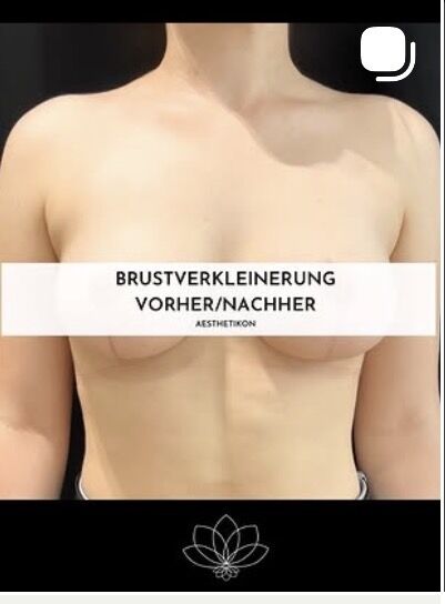 Brustverkleinerung Vorher/Nachher – Ergebnis bei AESTHETIKON