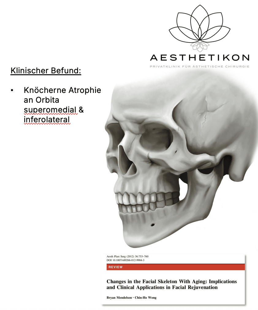 Knöcherne Atrophie des Gesichtsschädels an der Orbita superomedial und inferolateral nach Mendelson & Wong
