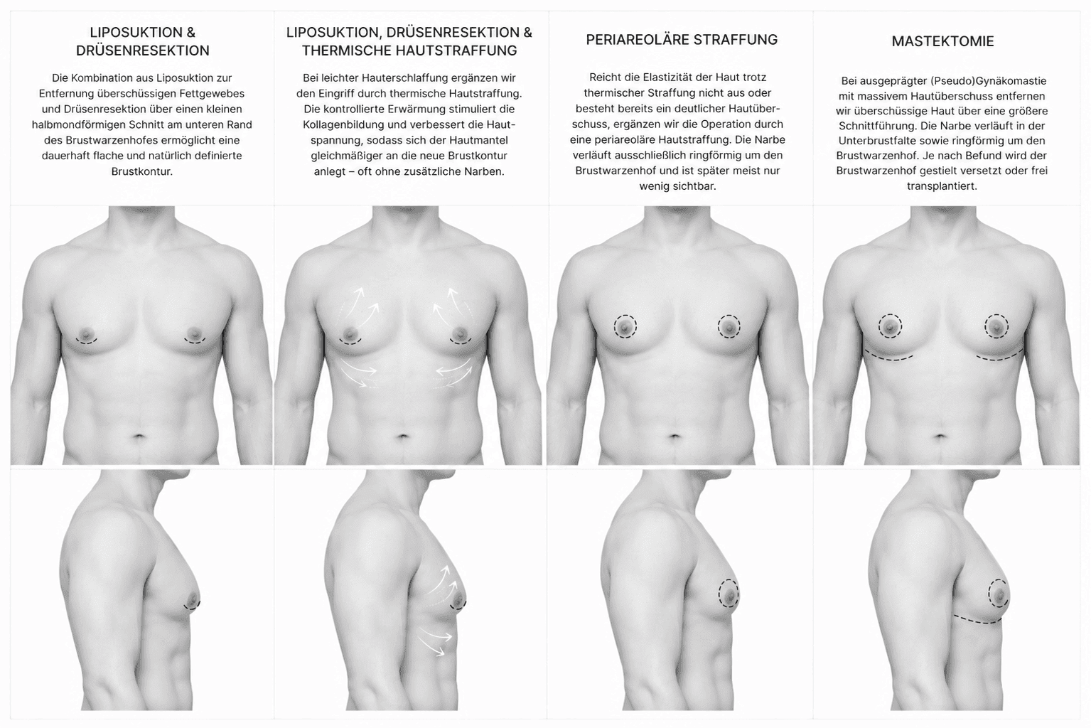 Behandlungstechniken der Gynäkomastie: Liposuktion und Drüsenresektion, thermische Hautstraffung, periareoläre Straffung und Mastektomie mit Narbenverlauf