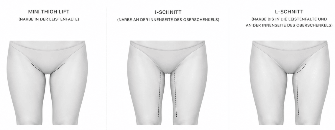 Narbenverlauf der Oberschenkelstraffung: Mini Thigh Lift in der Leistenfalte, I-Schnitt an der Innenseite und L-Schnitt kombiniert