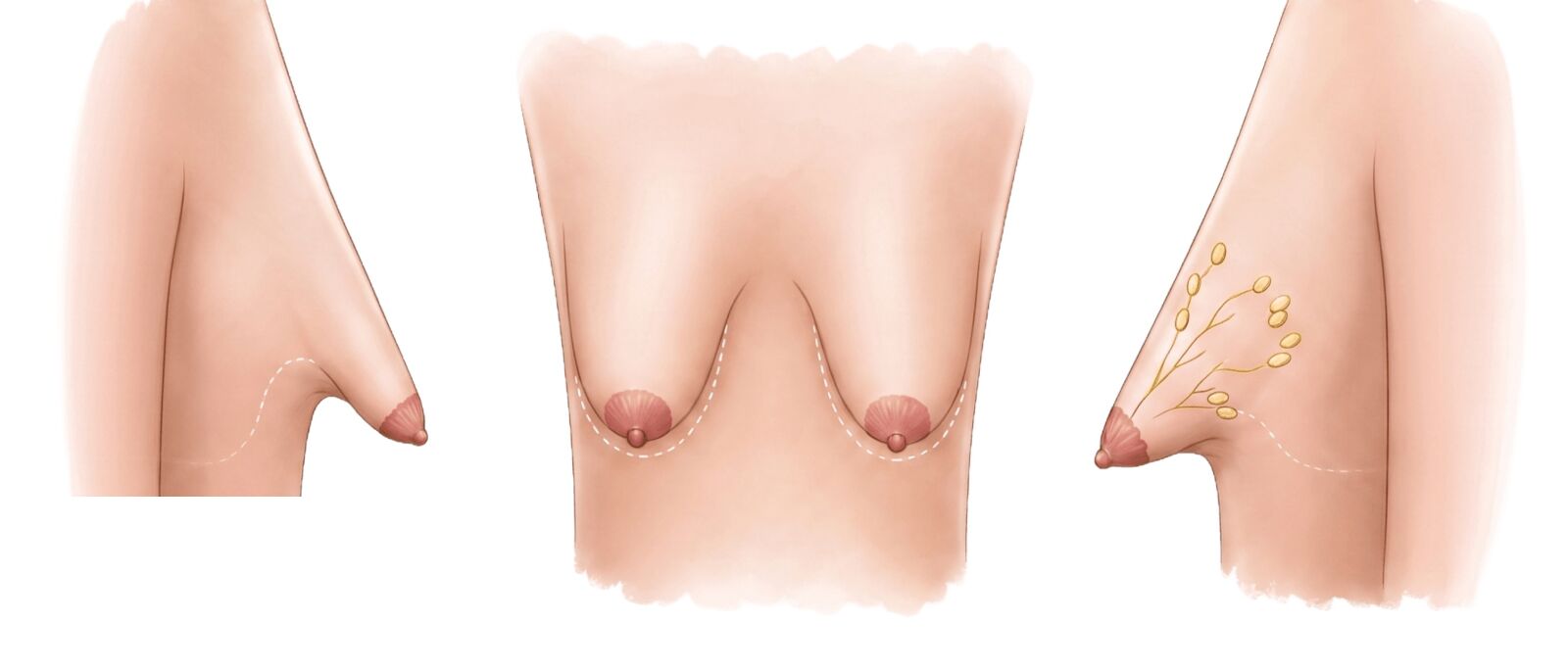Typische Merkmale der tuberösen Brust in Seiten- und Frontalansicht: eingeengte Brustbasis, verkürzter unterer Brustpol und areoläre Herniation