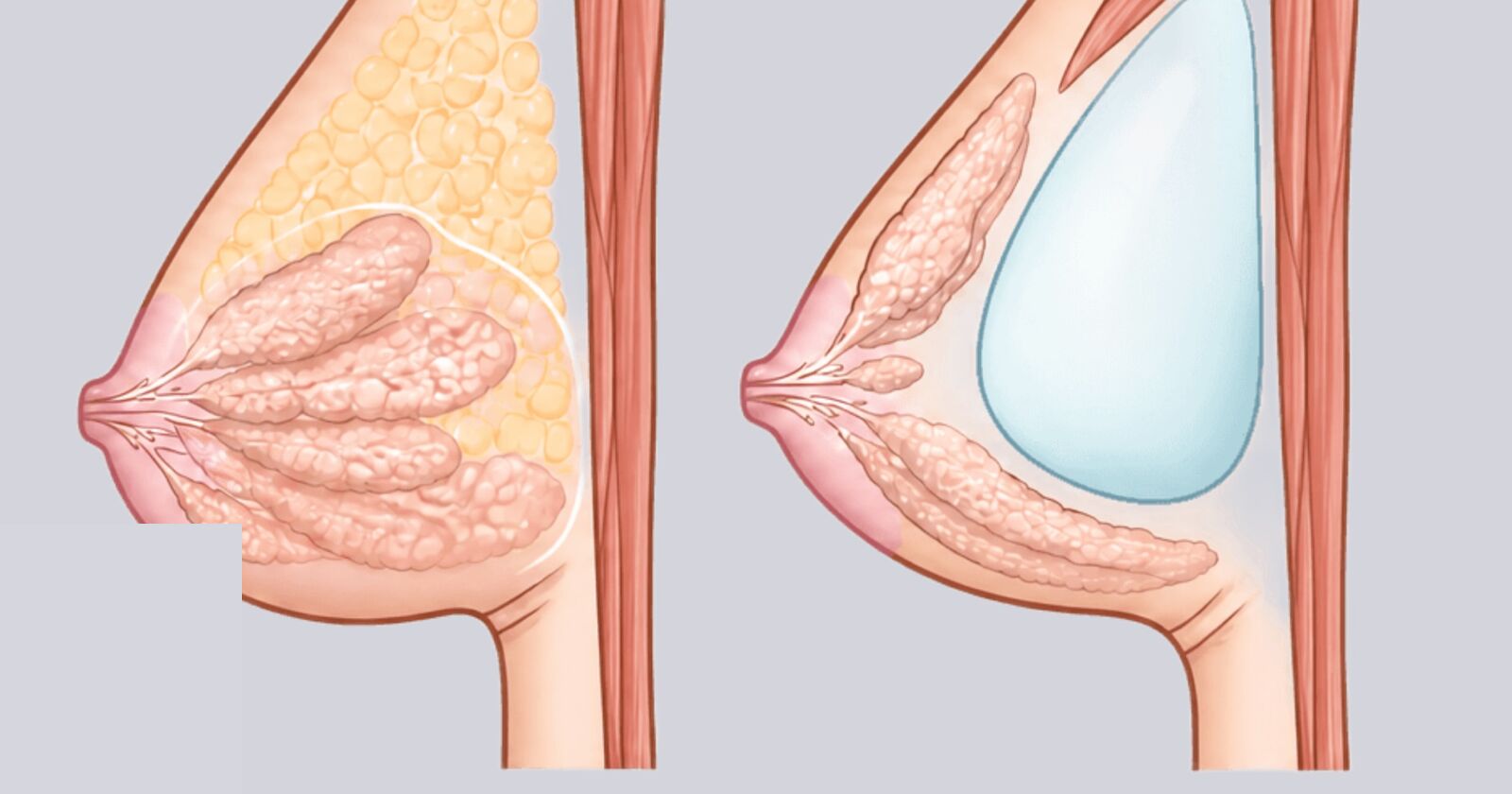 Volumenaufbau bei tuberöser Brust: Lipofilling mit Eigenfett oder Implantat in Dual-Plane-3-Technik