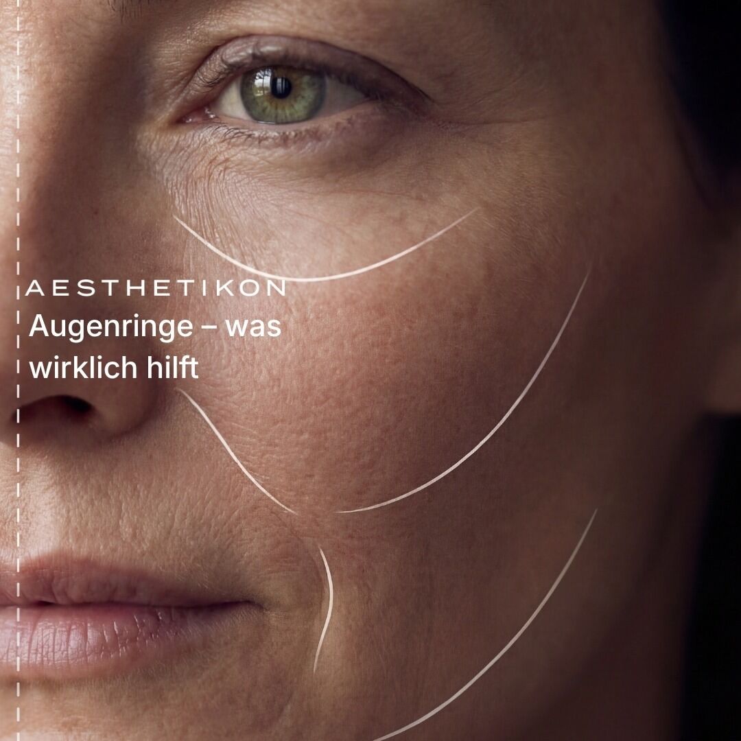 AESTHETIKON – Augenringe, was wirklich hilft: Nahaufnahme der Augen- und Wangenregion mit eingezeichneten Konturlinien