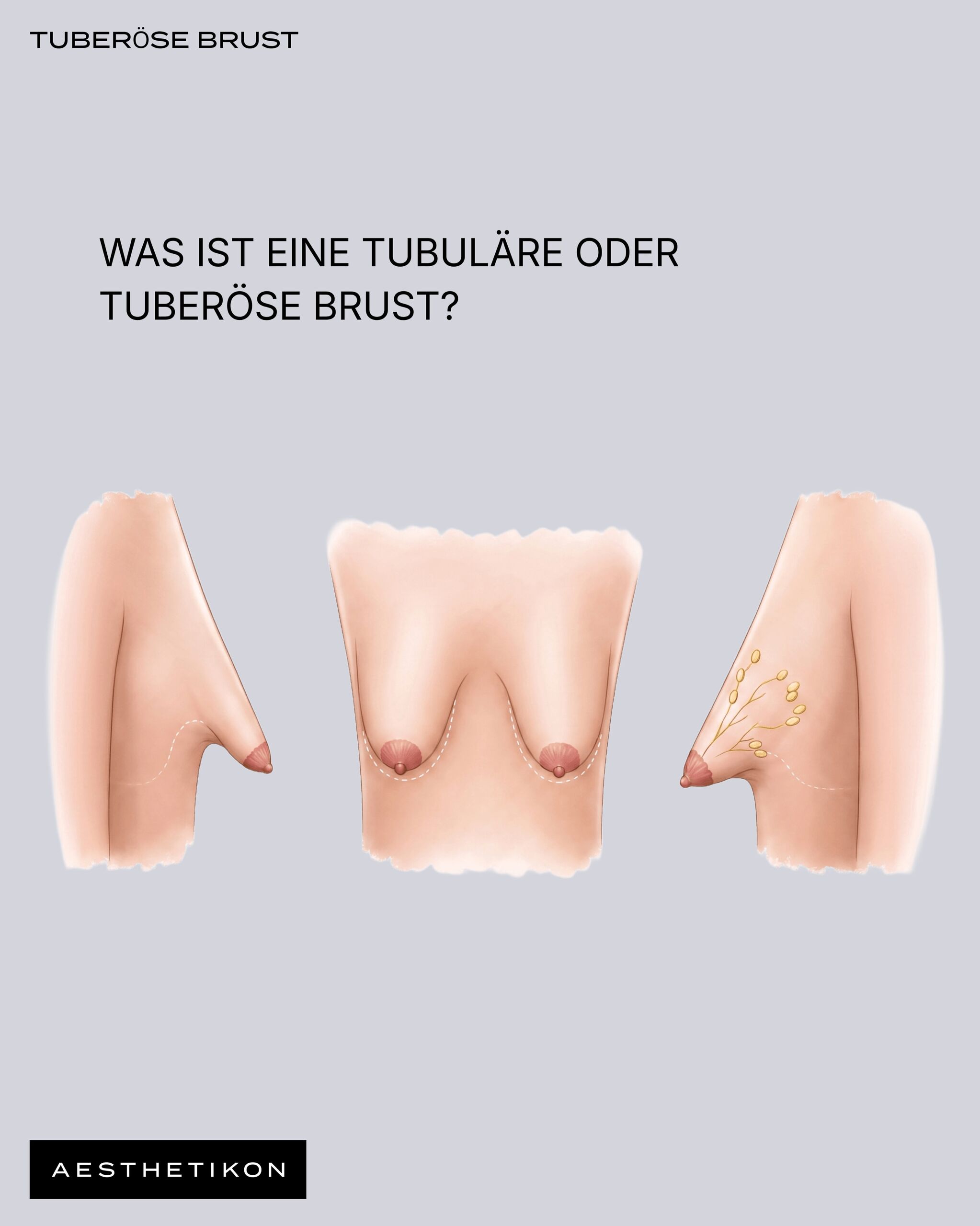 Anatomische Darstellung einer tuberösen Brust in Seiten- und Frontalansicht mit eingezeichneter Brustbasis und Drüsenverteilung