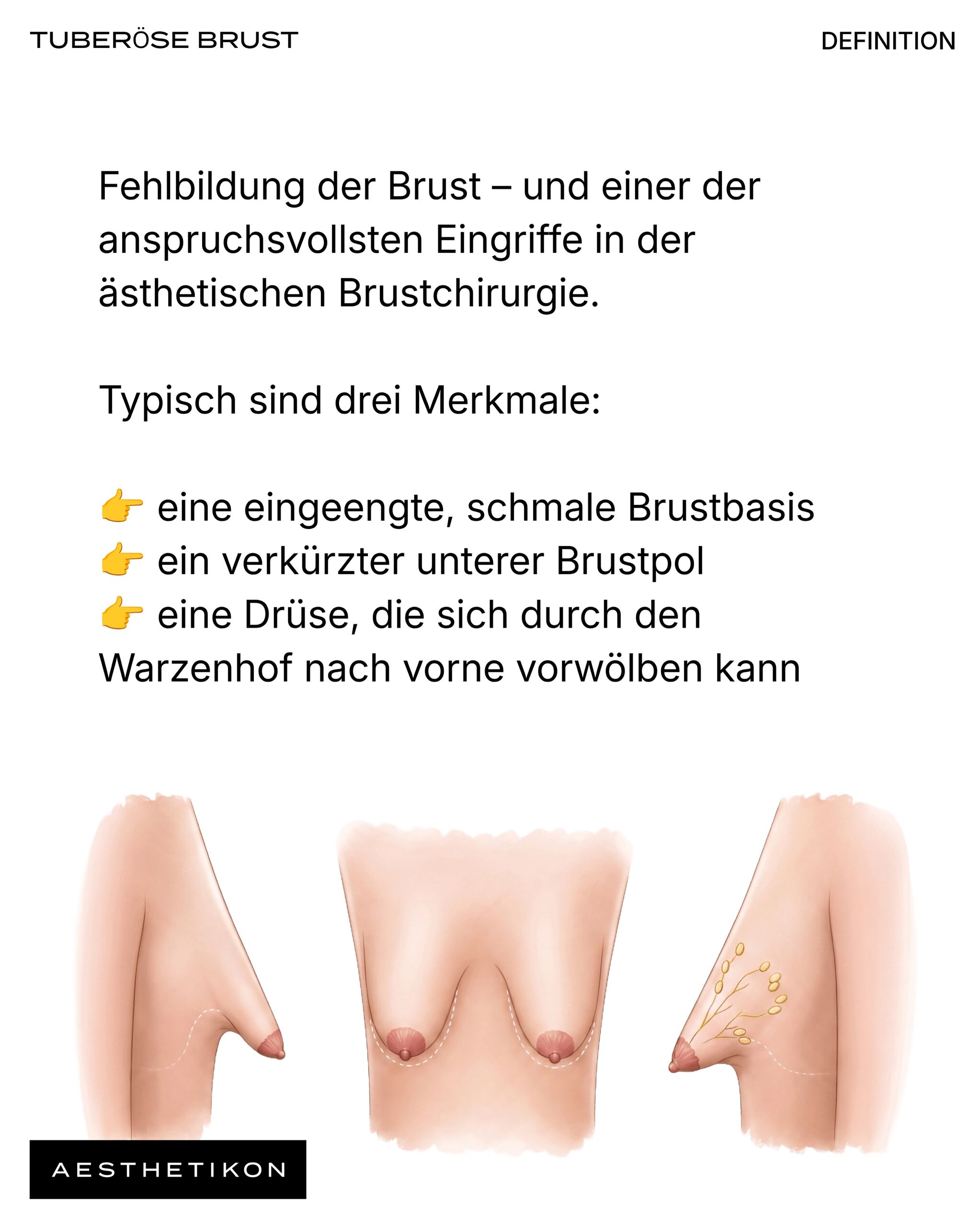 Definition der tuberösen Brust: Fehlbildung mit eingeengter schmaler Brustbasis, verkürztem unterem Brustpol und einer Drüse, die sich durch den Warzenhof nach vorne vorwölben kann