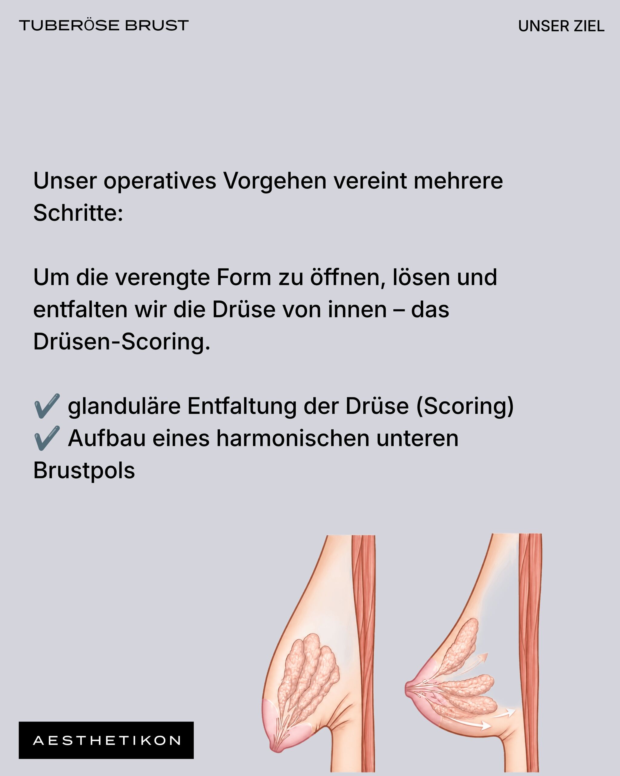 Operatives Vorgehen: Um die verengte Form zu öffnen, wird die Drüse von innen gelöst und entfaltet – das Drüsen-Scoring. Glanduläre Entfaltung der Drüse und Aufbau eines harmonischen unteren Brustpols, mit anatomischer Darstellung