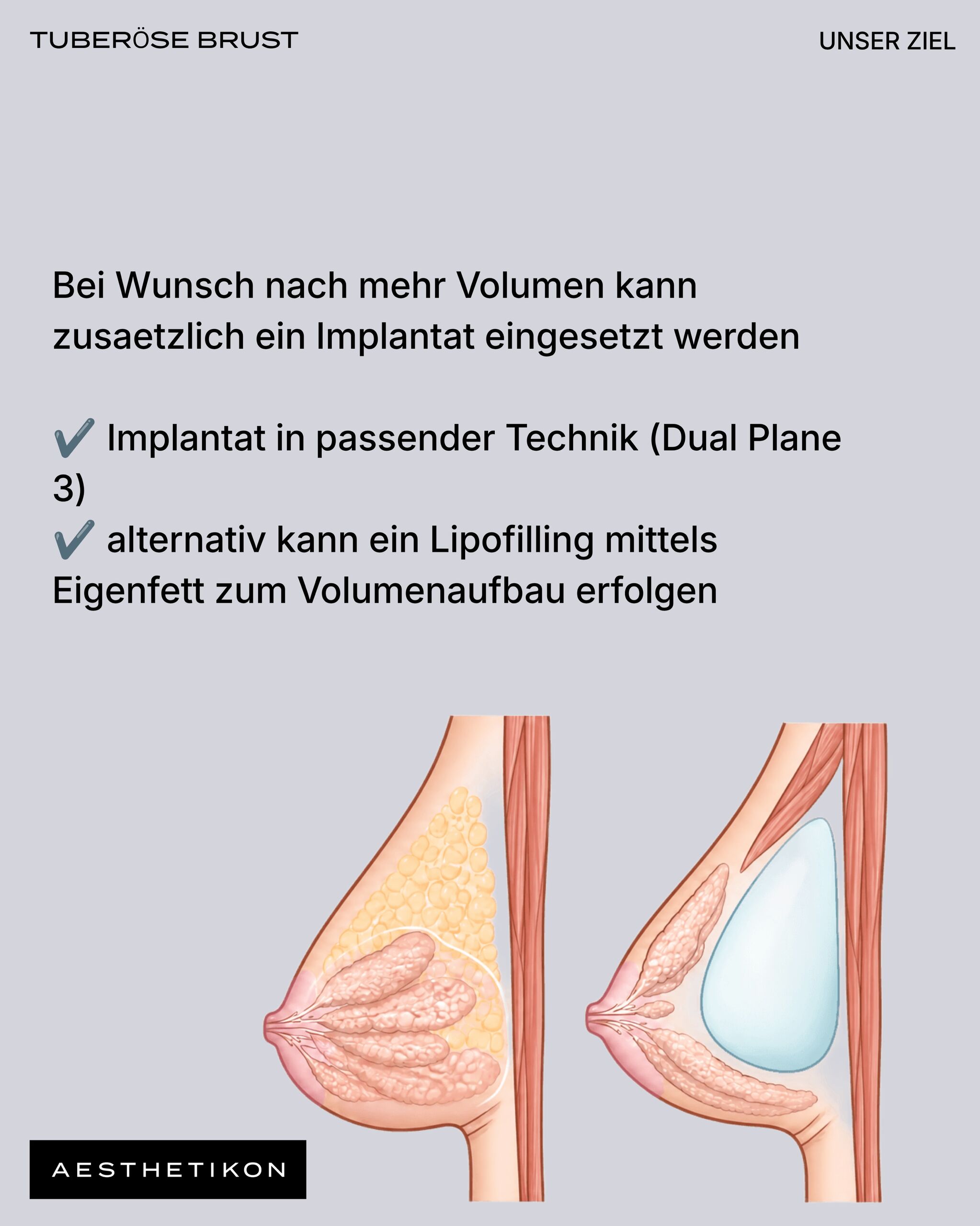 Bei Wunsch nach mehr Volumen kann zusätzlich ein Implantat in passender Technik (Dual Plane 3) eingesetzt werden, alternativ ein Lipofilling mittels Eigenfett – mit anatomischer Gegenüberstellung